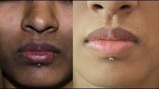 How To Remove Dark Spots, Black Patches, Hyper pigmentation _ Around Mouth | SuperWowStyle Prachi