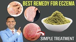 Best Natural Treatment For Eczema | How To Get Rid Of Eczema Naturally - Dr. Vivek Joshi