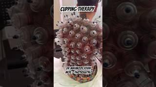 Cupping Therapy #cupping #cuppingtherapy #hijama #hijamatherapy #hijamaguy