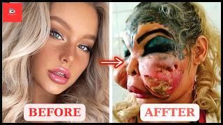 50 Celebrity Plastic Surgery Disasters Full | Then and Now 2025