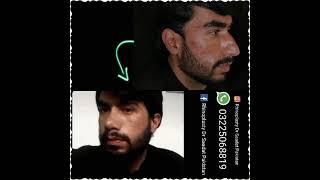 #reductionrhinoplasty #nosereshaping #rhinoplastyinpakistan #drsaadatullah