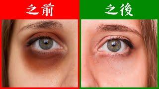 (眼睛11) 黑眼圈的原因, 外用和內服, 自然療法,柏格醫生 Dr Berg