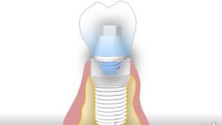 Prothetische Lösungen mit AWI Implantaten Fall 7