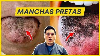 Língua com manchas pretas: O que pode ser?