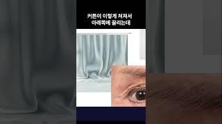 눈 처짐과 커튼 - 제이제이성형외과#shorts