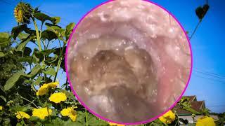 OMG ! How Earwax Is Professionally Extracted _ Ep 01