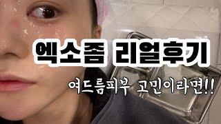 vlog. 엑소좀 스킨부스터 | 엑소좀 | 피부관리 | 엑소좀 리얼후기 | 여드름피부 | 피부시술