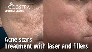 Acne scars - Treatment with laser and fillers - 24057