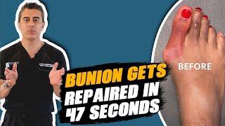 Bunion GONE in Just 47 Seconds!  #bunions #foothealth