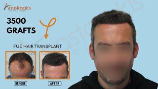  9-Month Follow-Up After FUE Hair Transplant with 3500 Grafts | Anastasakis Hair Clinic  Case #300