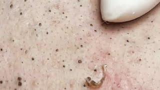 LOOK AT THIS FACE HOW IS FULL OF BLACKHEADS SATISFYING VIDEO #relaxing #blackheads