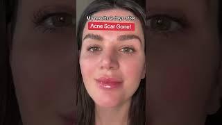 How To Fade Acne Scars Quickly With This Skincare Kit #acne #acnescars #microneedling