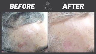 Sun Damage Removal Treatment | Skin Spa Specialist for Skincare | ICLS Dermatology & Plastic Surgery