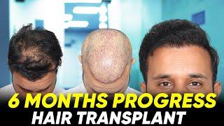 Hair Transplant in Chennai | Best Results & Cost of Hair Transplant in Chennai