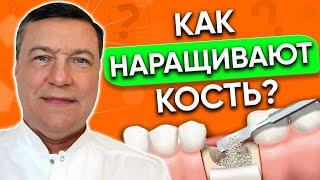 Наращивание костной ткани для ИМПЛАНТАЦИИ зубов