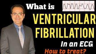 Ventricular Fibrillation (V. Fib) ECG Interpretation Explained, Treatment, Management, USMLE, NCLEX