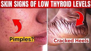 7 Skin Signs of Low Thyroid Levels: What Your Skin is Telling You?