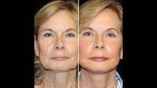 Client Experience After Facelift at Faces Plus