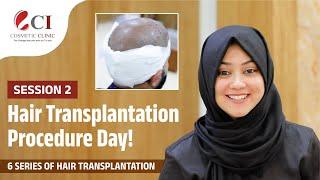 Hair Transplantation Procedure Day! | Session 2 |  6 Series of HT