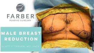 Male Breast Reduction Surgery (Gynecomastia) by Scott T. Farber, MD FACS