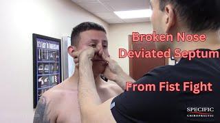 Broken Nose, Deviated Septum from Fist Fight