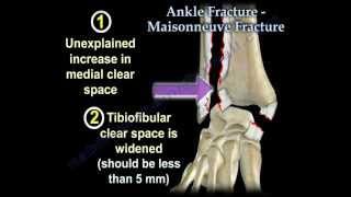 Ankle Fracture Maisonneuve Fracture - Everything You Need To Know - Dr. Nabil Ebraheim