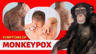 What is Monkeypox? Symptoms, Sign & Cases Detected Countries for Monkeypox