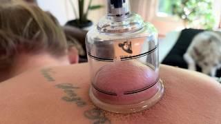 Cupping Therapy Tutorial