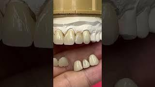 Metal Ceramics vs. Monet Pure Zirconia Ceramics