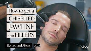 Chiseled Jawline with Fillers| Total Transformation | Before and Afters Jawline filler 2022