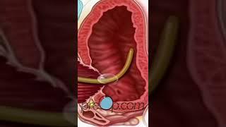 TURP Transurethral Resection Prostate - PreOp® Patient Education & Patient Engagement #shorts