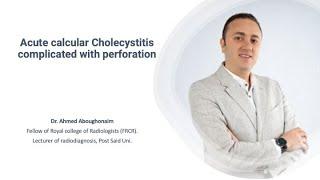 | GIT | ER | Acute calcular Cholecystitis complicated with perforation