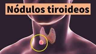 Thyroid nodules: symptoms, diagnosis, treatment and prevention (lump or ball in the neck)