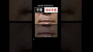 남자 인중세로주름 절대 하지말라고? 효과는 어느정도...#입술주름 #인중세로주름 #신촌성형외과 #홍대성형외과 #은평성형외과 #마포성형외과 #연세자연미 #입술고양이주름
