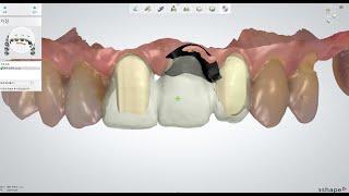 3shape Shell Crown 3unit bridge case design/쉘크라운(디지털템포) 3번브릿지케이스 영상/제일 중요한 것은...???