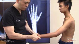 Can't Bend Fingers after Injury HELPED by Dr Suh