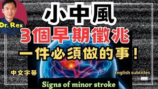 小中風後必定要做的一件事！what is minor stroke and what must be done after an attack?