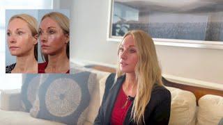 52 and Fabulous: Deep Plane Facelift Results at 1 Month Post-Op | Why She Didn’t Wait! #facelift