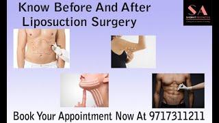 Know Before And After Liposuction Surgery | Dr. Shobhit Gupta | Liposuction Surgery Procedure