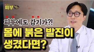 다른 피부염과 헷갈리기 쉬운 ‘장미색 비강진’ 구별법! - 박치영의 피부 톡톡 #151