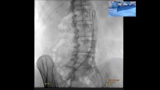 Hemorrhoid Embolization Live Case Recording