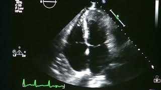 Atrial Fibrillation On Echocardiogram