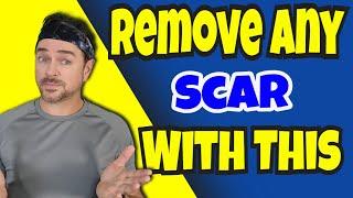 Get Rid Of ANY Scar With This? | Chris Gibson