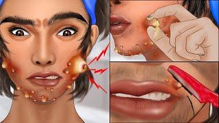 ASMR Popping pustule in jawline and face shaving  Squeeze acne animation