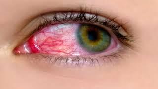 Что делать если глаз красный и болит