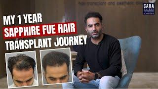 The Journey to Happiness: 1 Year of Hair Transplant Success