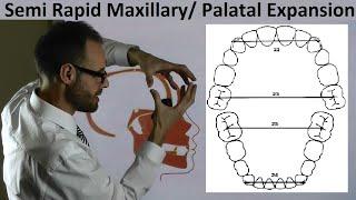 Mechanism of Semi Rapid Palatal/ Maxillary Expansion & Teeth Position on Arches by Dr Mike Mew