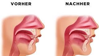 So erfolgt die Operation und die Heilung der Schlafapnoe