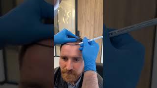 Hair Transplant in Turkey | Hair Transplant Process #hairtransplant