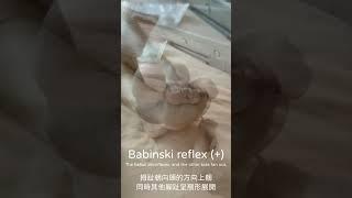 Babinski reflex at bedside #shorts #medicine #neurology #doctor